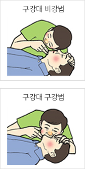 구강대 비강법, 구강개 구강법 처치 사진