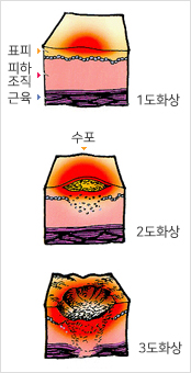 표피,피하,조직,근육을 이미지화 시켜 1도화상 수포2도화상,3도화상을 보여준 이미지
