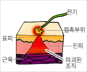 표피,진피,파괴된 조직,근육으로 구성된 이미지에 전기화상 시 발생하는 접촉부위 상태 이미지